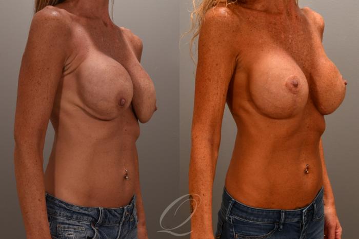 Breast Augmentation Revision Case 1001656 Before & After Right Oblique | Serving Rochester, Syracuse & Buffalo, NY | Quatela Center for Plastic Surgery