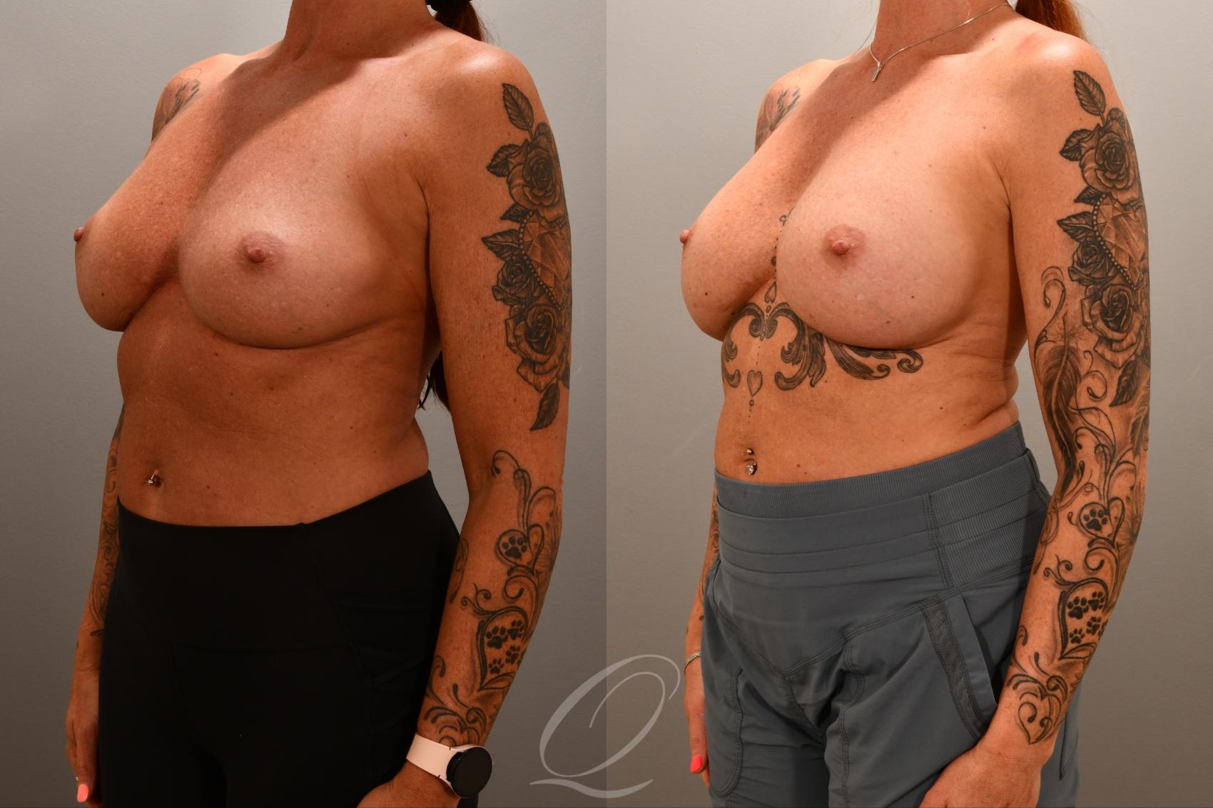 Breast Augmentation Revision Case 1001852 Before & After Left Oblique | Serving Rochester, Syracuse & Buffalo, NY | Quatela Center for Plastic Surgery