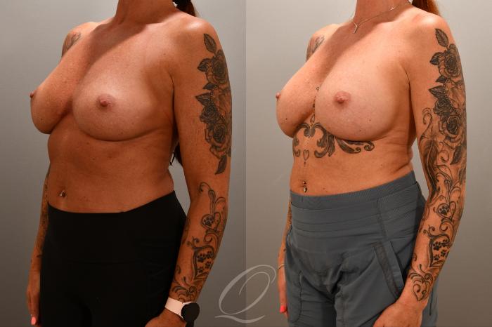 Breast Augmentation Revision Case 1001852 Before & After Left Oblique | Serving Rochester, Syracuse & Buffalo, NY | Quatela Center for Plastic Surgery