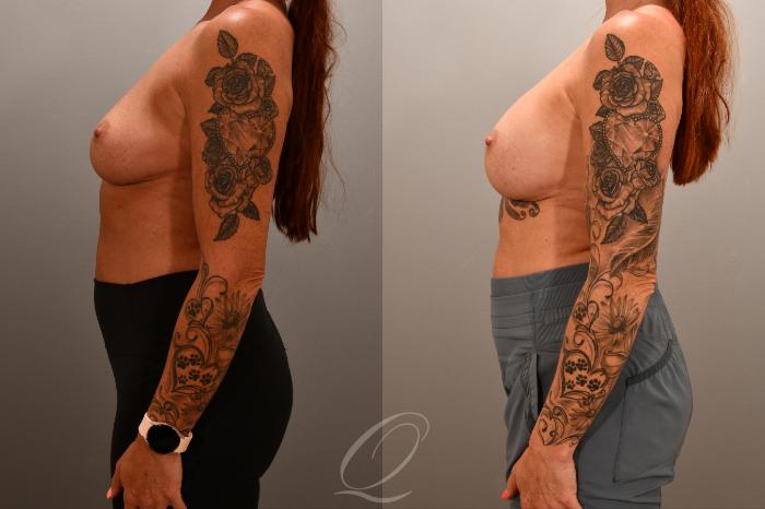Breast Augmentation Revision Case 1001852 Before & After Left Side | Serving Rochester, Syracuse & Buffalo, NY | Quatela Center for Plastic Surgery