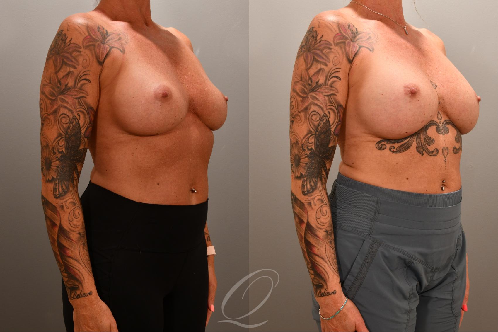Breast Augmentation Revision Case 1001852 Before & After Right Oblique | Serving Rochester, Syracuse & Buffalo, NY | Quatela Center for Plastic Surgery