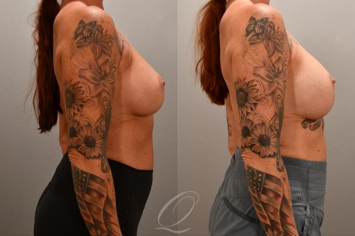 Breast Augmentation Revision Case 1001852 Before & After Right Side | Serving Rochester, Syracuse & Buffalo, NY | Quatela Center for Plastic Surgery