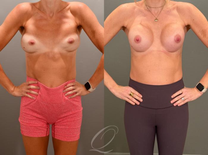 Breast Augmentation Revision Case 1001853 Before & After Arms Flexed | Serving Rochester, Syracuse & Buffalo, NY | Quatela Center for Plastic Surgery