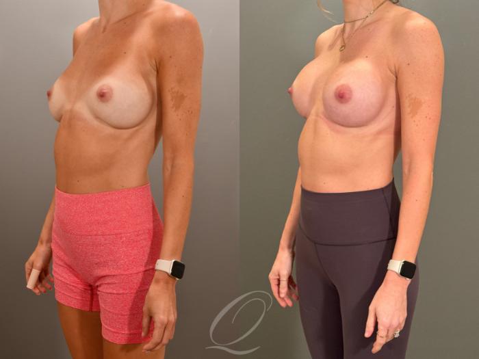 Breast Augmentation Revision Case 1001853 Before & After Left Oblique | Serving Rochester, Syracuse & Buffalo, NY | Quatela Center for Plastic Surgery
