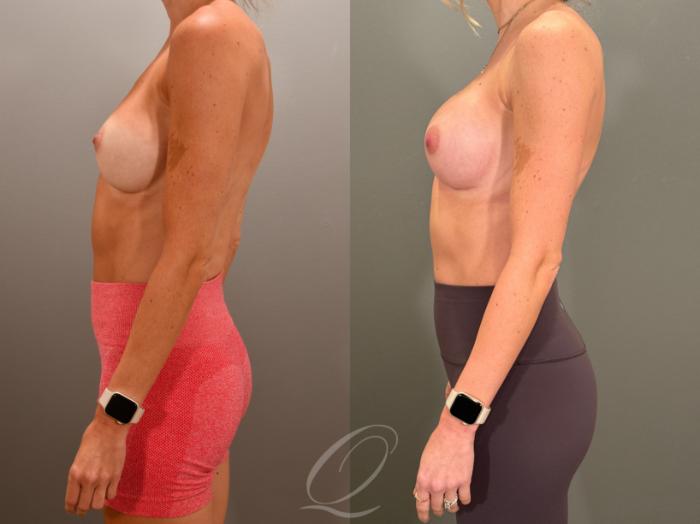 Breast Augmentation Revision Case 1001853 Before & After Left Side | Serving Rochester, Syracuse & Buffalo, NY | Quatela Center for Plastic Surgery