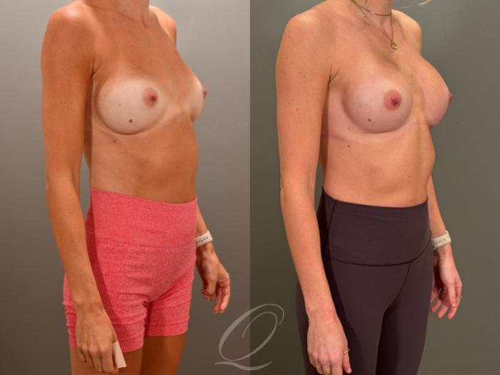 Breast Augmentation Revision Case 1001853 Before & After Right Oblique | Serving Rochester, Syracuse & Buffalo, NY | Quatela Center for Plastic Surgery