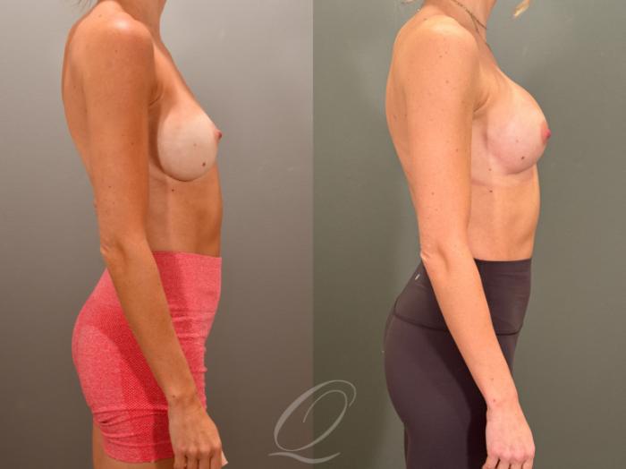 Breast Augmentation Revision Case 1001853 Before & After Right Side | Serving Rochester, Syracuse & Buffalo, NY | Quatela Center for Plastic Surgery