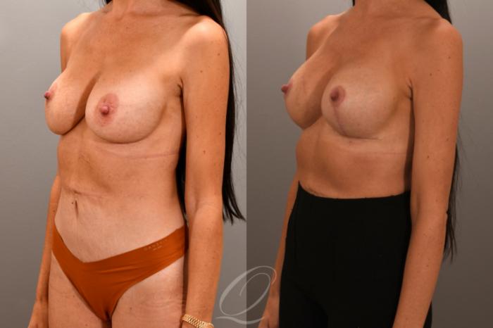 Breast Augmentation Revision Case 1001868 Before & After Left Oblique | Serving Rochester, Syracuse & Buffalo, NY | Quatela Center for Plastic Surgery