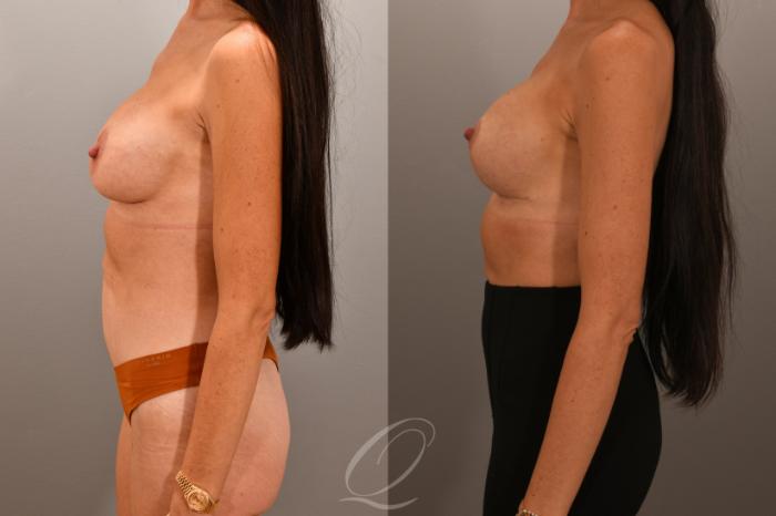 Breast Augmentation Revision Case 1001868 Before & After Left Side | Serving Rochester, Syracuse & Buffalo, NY | Quatela Center for Plastic Surgery