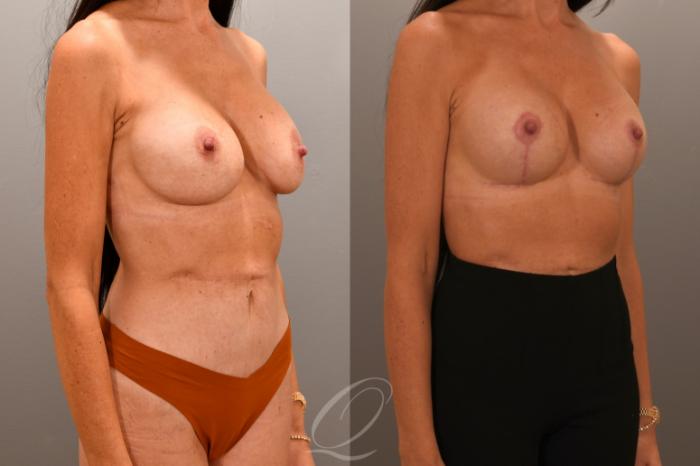 Breast Augmentation Revision Case 1001868 Before & After Right Oblique | Serving Rochester, Syracuse & Buffalo, NY | Quatela Center for Plastic Surgery