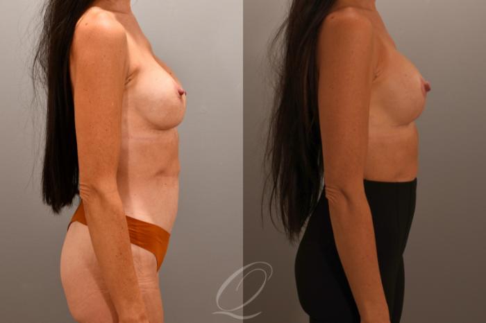 Breast Augmentation Revision Case 1001868 Before & After Right Side | Serving Rochester, Syracuse & Buffalo, NY | Quatela Center for Plastic Surgery