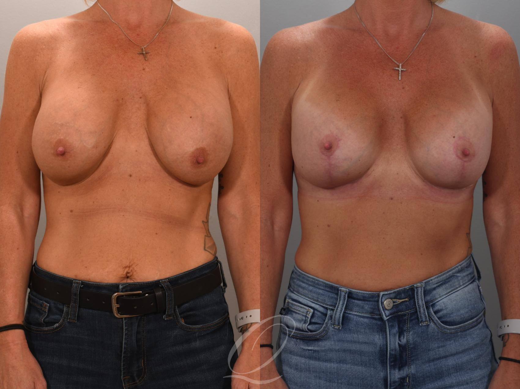 Breast Augmentation Revision Case 1001949 Before & After Front | Serving Rochester, Syracuse & Buffalo, NY | Quatela Center for Plastic Surgery