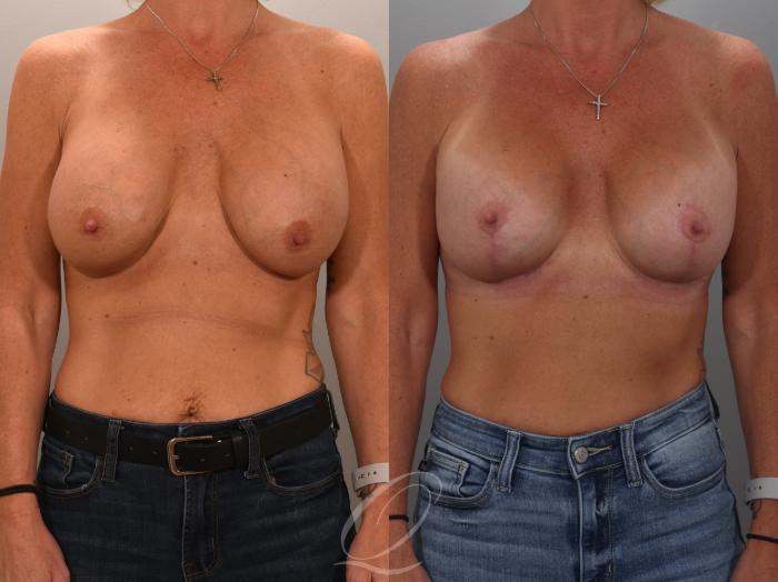Breast Augmentation Revision Case 1001949 Before & After Front | Serving Rochester, Syracuse & Buffalo, NY | Quatela Center for Plastic Surgery