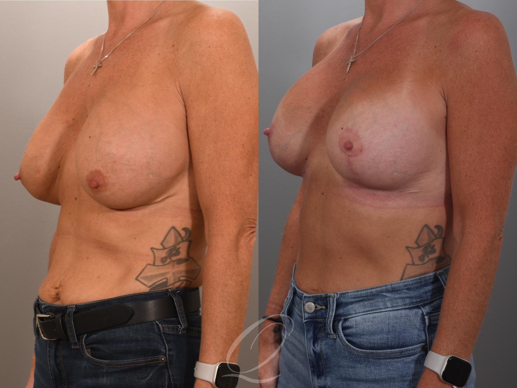 Breast Augmentation Revision Case 1001949 Before & After Left Oblique | Serving Rochester, Syracuse & Buffalo, NY | Quatela Center for Plastic Surgery