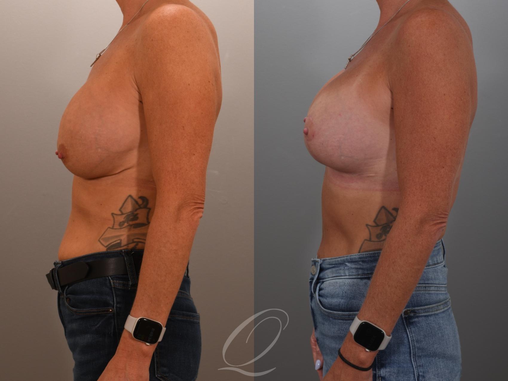 Breast Augmentation Revision Case 1001949 Before & After Left Side | Serving Rochester, Syracuse & Buffalo, NY | Quatela Center for Plastic Surgery