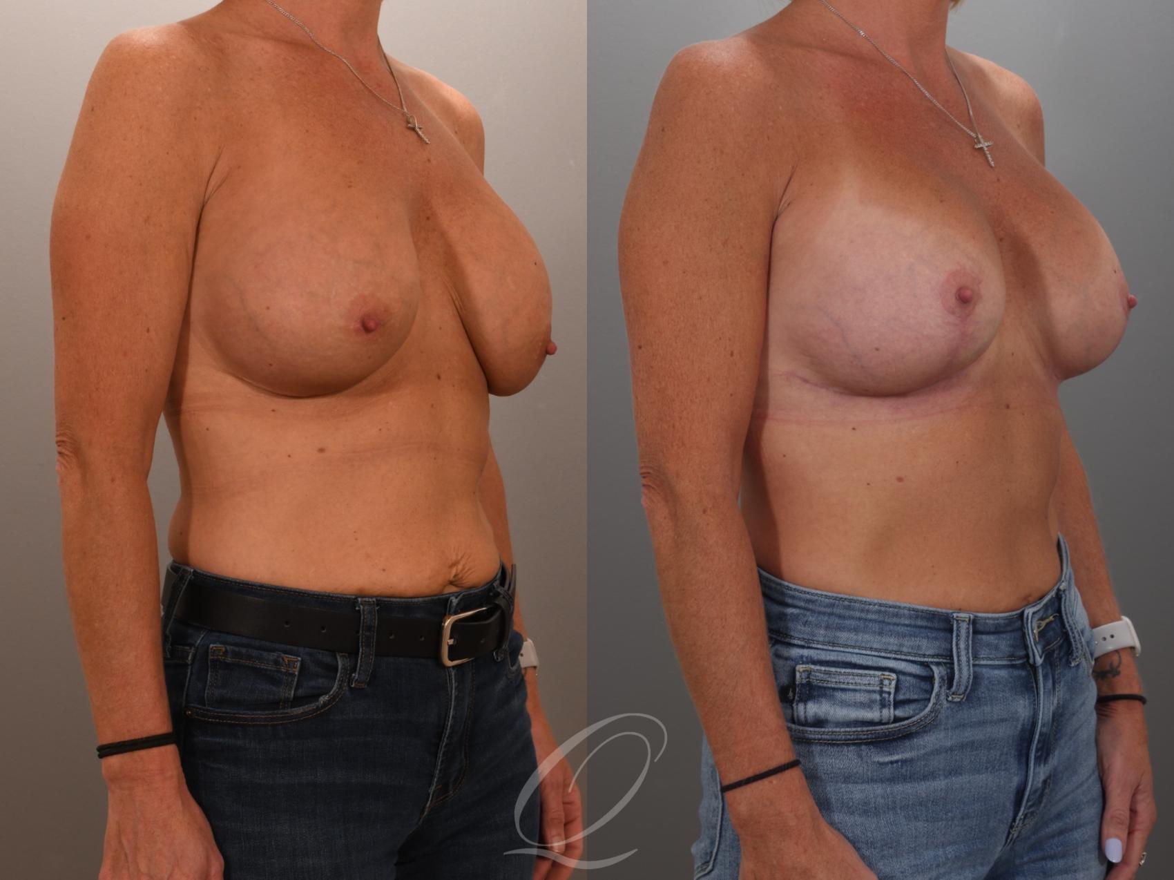 Breast Augmentation Revision Case 1001949 Before & After Right Oblique | Serving Rochester, Syracuse & Buffalo, NY | Quatela Center for Plastic Surgery