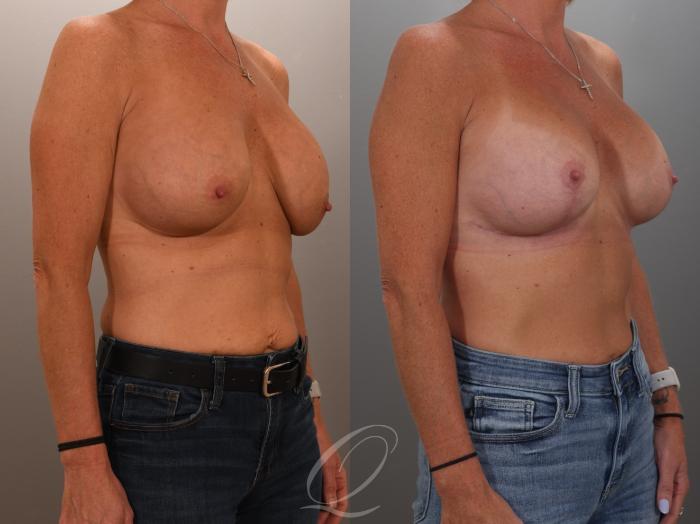 Breast Augmentation Revision Case 1001949 Before & After Right Oblique | Serving Rochester, Syracuse & Buffalo, NY | Quatela Center for Plastic Surgery
