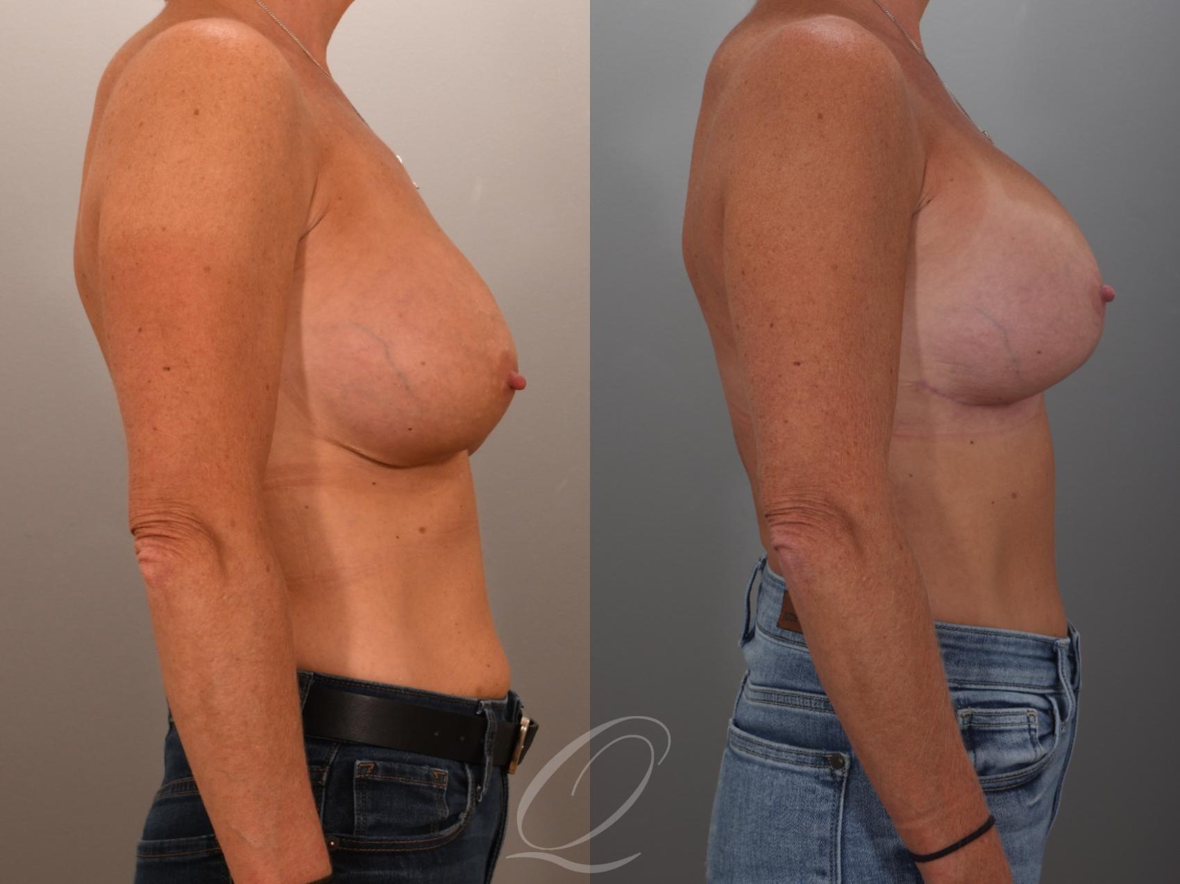 Breast Augmentation Revision Case 1001949 Before & After Right Side | Serving Rochester, Syracuse & Buffalo, NY | Quatela Center for Plastic Surgery