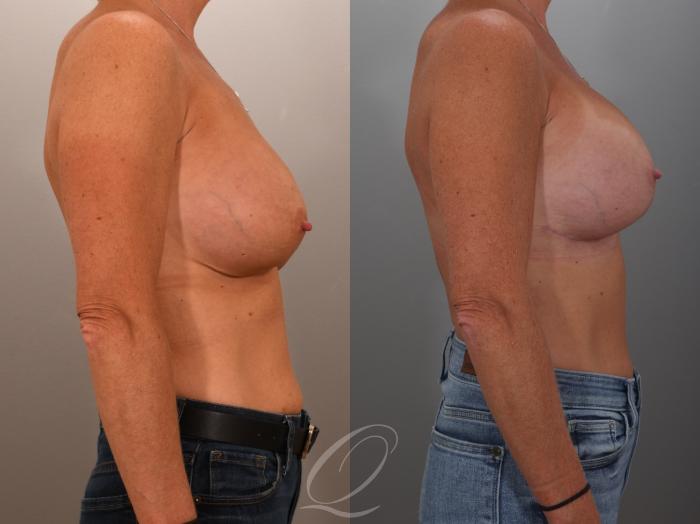 Breast Augmentation Revision Case 1001949 Before & After Right Side | Serving Rochester, Syracuse & Buffalo, NY | Quatela Center for Plastic Surgery