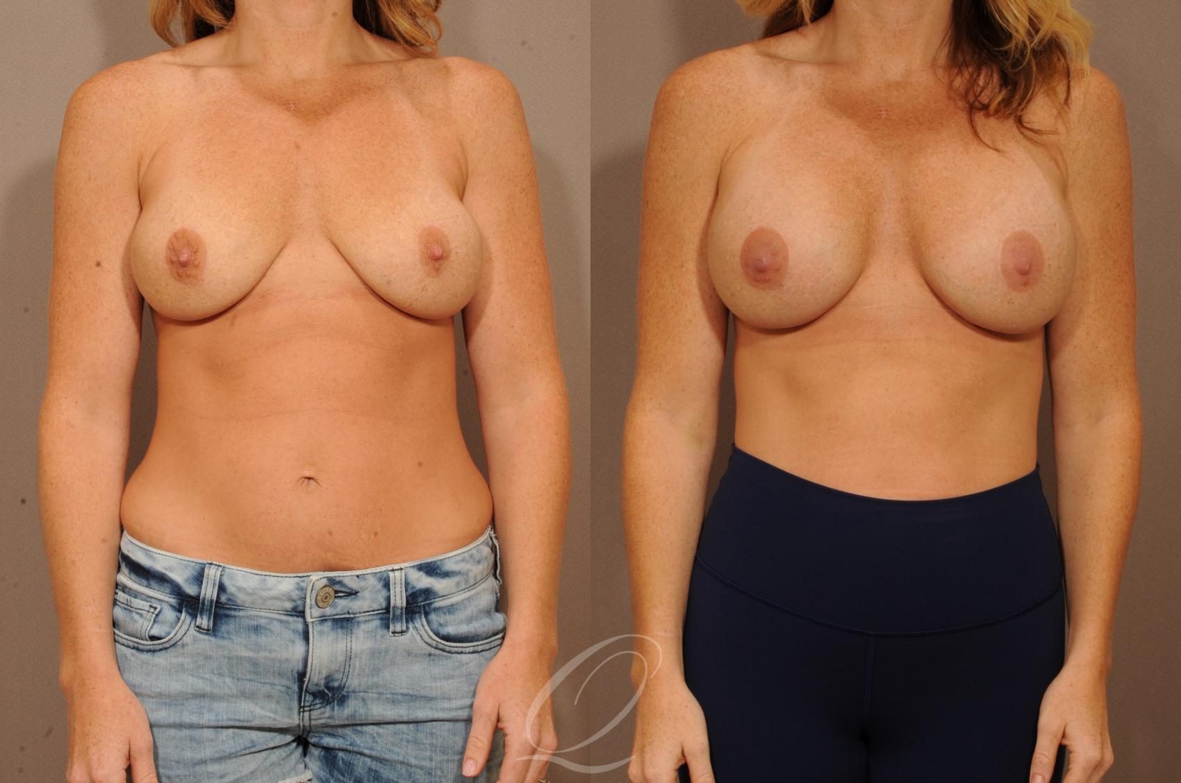 Breast Augmentation Revision Case 1137 Before & After View #1 | Serving Rochester, Syracuse & Buffalo, NY | Quatela Center for Plastic Surgery