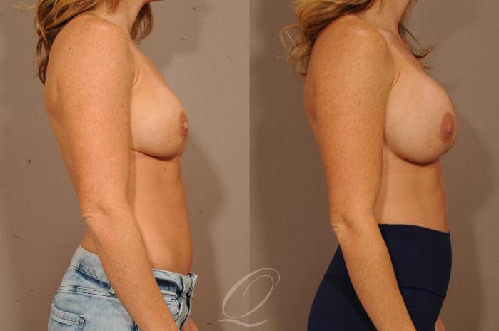 Breast Augmentation Revision Case 1137 Before & After View #3 | Serving Rochester, Syracuse & Buffalo, NY | Quatela Center for Plastic Surgery