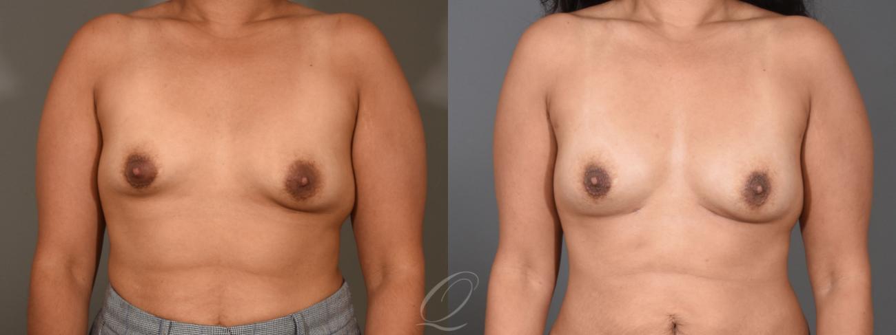 Breast Augmentation with Fat Transfer Case 1408 Before & After Front | Serving Rochester, Syracuse & Buffalo, NY | Quatela Center for Plastic Surgery