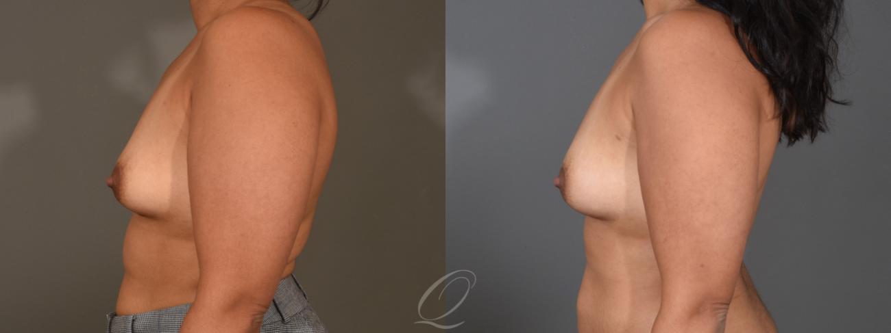 Breast Augmentation with Fat Transfer Case 1408 Before & After Left Side | Serving Rochester, Syracuse & Buffalo, NY | Quatela Center for Plastic Surgery