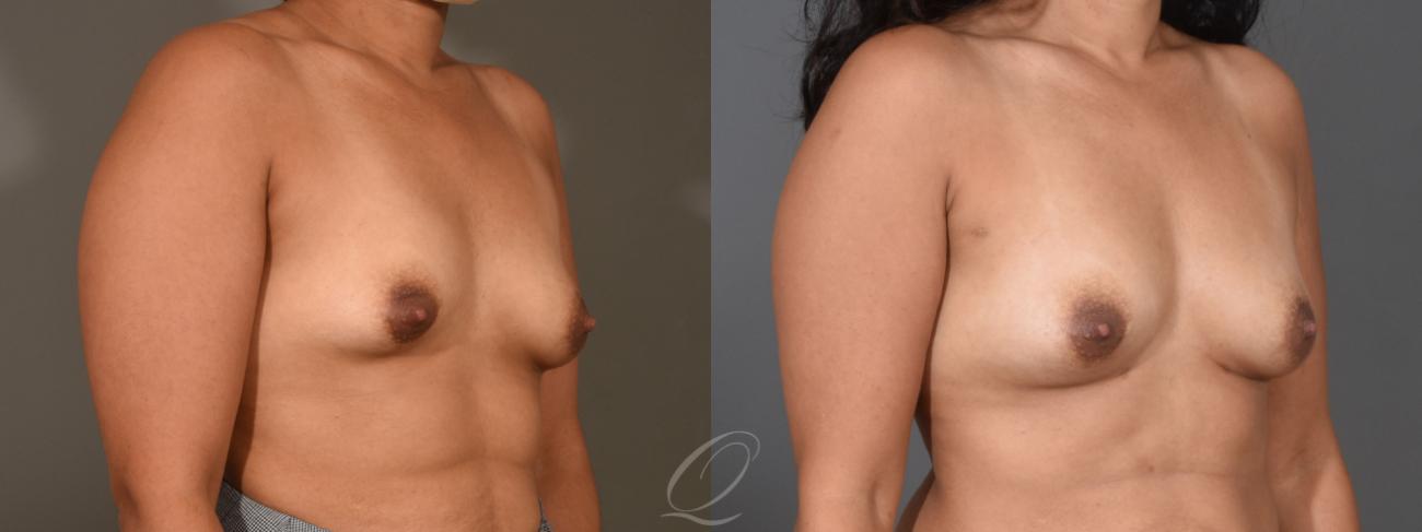 Breast Augmentation with Fat Transfer Case 1408 Before & After Right Oblique | Serving Rochester, Syracuse & Buffalo, NY | Quatela Center for Plastic Surgery
