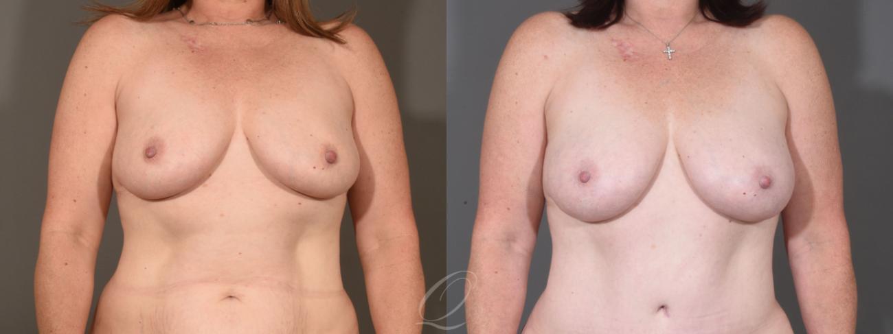 Breast Augmentation with Fat Transfer Case 1409 Before & After Front | Serving Rochester, Syracuse & Buffalo, NY | Quatela Center for Plastic Surgery