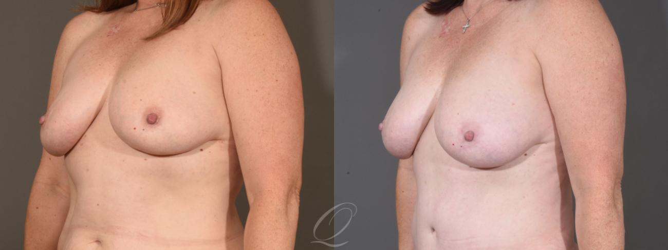 Breast Augmentation with Fat Transfer Case 1409 Before & After Left Oblique | Serving Rochester, Syracuse & Buffalo, NY | Quatela Center for Plastic Surgery