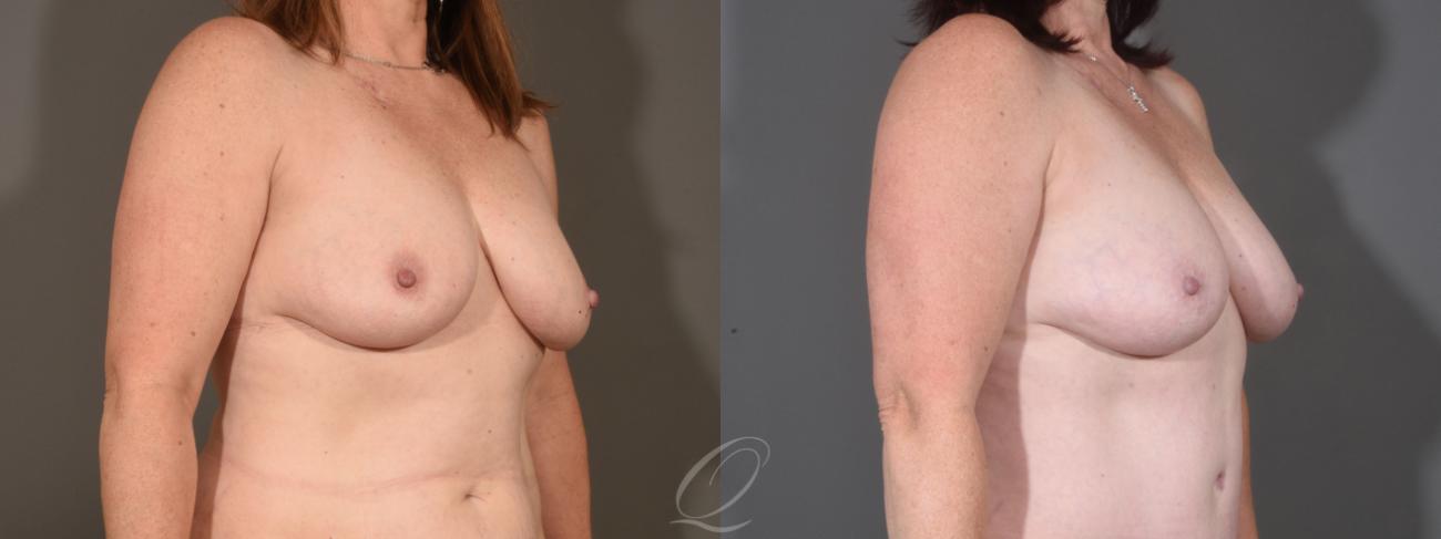 Breast Augmentation with Fat Transfer Case 1409 Before & After Right Oblique | Serving Rochester, Syracuse & Buffalo, NY | Quatela Center for Plastic Surgery