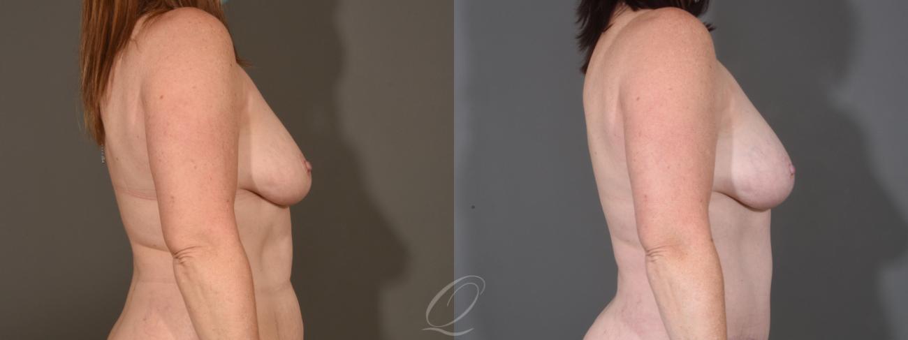 Breast Augmentation with Fat Transfer Case 1409 Before & After Right Side | Serving Rochester, Syracuse & Buffalo, NY | Quatela Center for Plastic Surgery