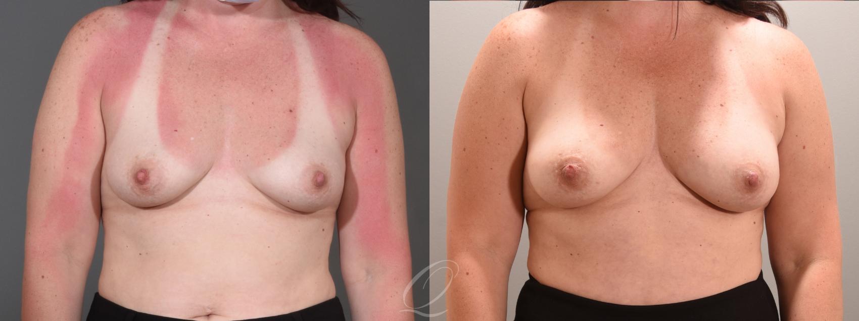 Breast Augmentation with Fat Transfer Case 1001565 Before & After Front | Serving Rochester, Syracuse & Buffalo, NY | Quatela Center for Plastic Surgery