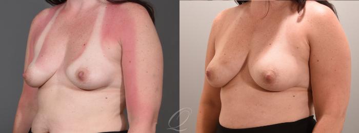 Breast Augmentation with Fat Transfer Case 1001565 Before & After Left Oblique | Serving Rochester, Syracuse & Buffalo, NY | Quatela Center for Plastic Surgery