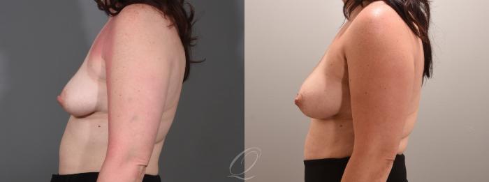 Breast Augmentation with Fat Transfer Case 1001565 Before & After Left Side | Serving Rochester, Syracuse & Buffalo, NY | Quatela Center for Plastic Surgery
