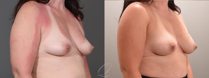 Breast Augmentation with Fat Transfer Case 1001565 Before & After Right Oblique | Serving Rochester, Syracuse & Buffalo, NY | Quatela Center for Plastic Surgery