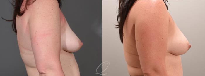Breast Augmentation with Fat Transfer Case 1001565 Before & After Right Side | Serving Rochester, Syracuse & Buffalo, NY | Quatela Center for Plastic Surgery