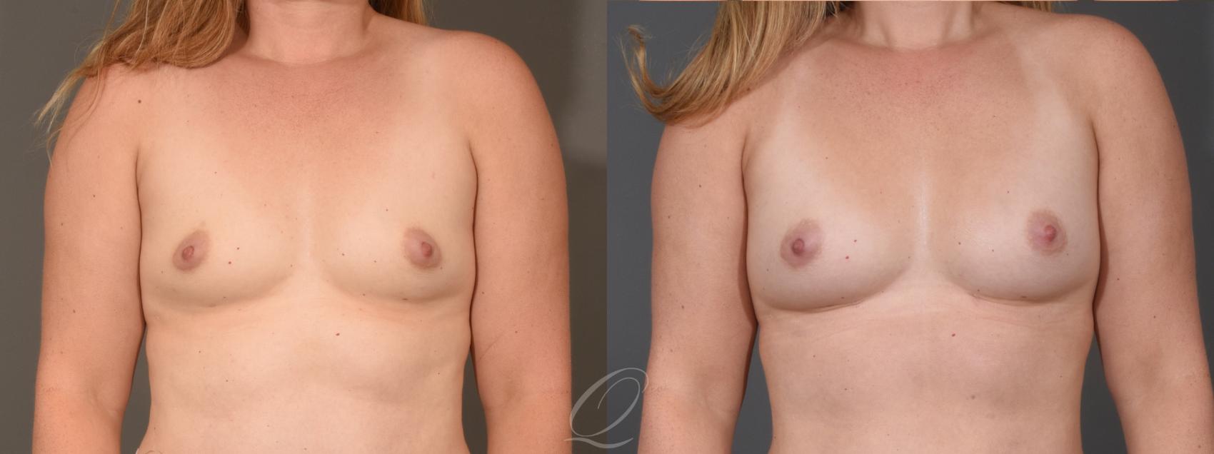 Breast Augmentation with Fat Transfer Case 1001566 Before & After Front | Serving Rochester, Syracuse & Buffalo, NY | Quatela Center for Plastic Surgery