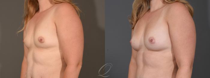 Breast Augmentation with Fat Transfer Case 1001566 Before & After Left Oblique | Serving Rochester, Syracuse & Buffalo, NY | Quatela Center for Plastic Surgery