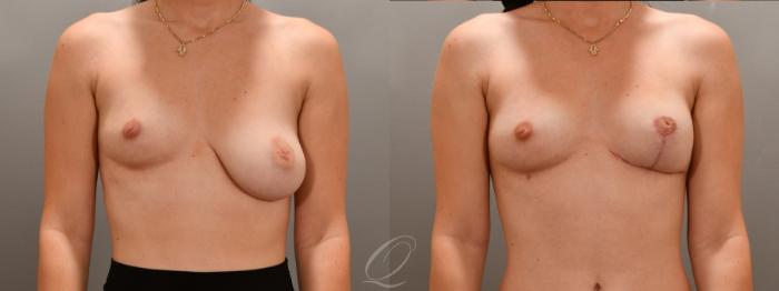 Breast Lift Case 1001607 Before & After Front | Serving Rochester, Syracuse & Buffalo, NY | Quatela Center for Plastic Surgery