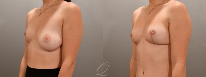 Breast Lift Case 1001607 Before & After Left Oblique | Serving Rochester, Syracuse & Buffalo, NY | Quatela Center for Plastic Surgery
