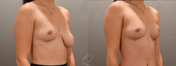 Breast Augmentation with Fat Transfer Case 1001607 Before & After Right Oblique | Serving Rochester, Syracuse & Buffalo, NY | Quatela Center for Plastic Surgery