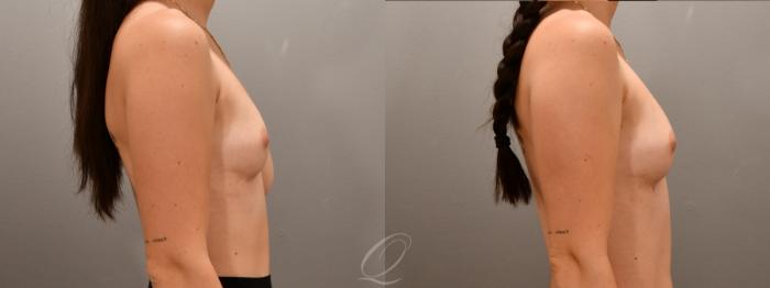 Breast Augmentation with Fat Transfer Case 1001607 Before & After Right Side | Serving Rochester, Syracuse & Buffalo, NY | Quatela Center for Plastic Surgery