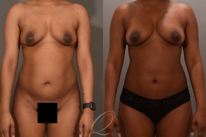Breast Augmentation with Fat Transfer Case 1001728 Before & After Front | Serving Rochester, Syracuse & Buffalo, NY | Quatela Center for Plastic Surgery