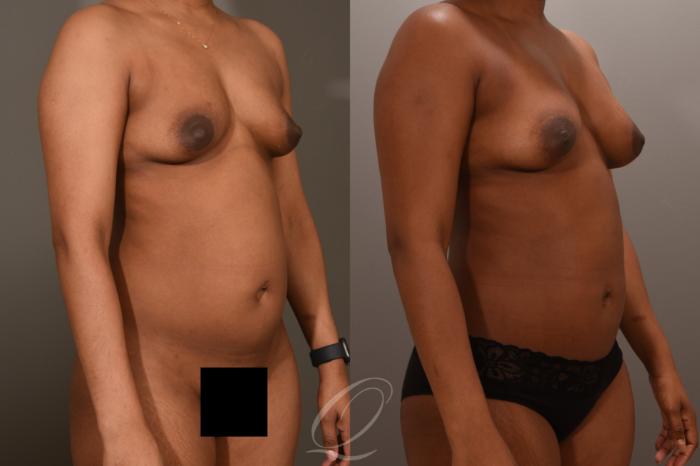 Breast Augmentation with Fat Transfer Case 1001728 Before & After Right Oblique | Serving Rochester, Syracuse & Buffalo, NY | Quatela Center for Plastic Surgery