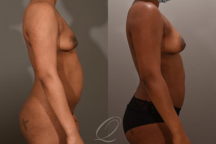 Breast Augmentation with Fat Transfer Case 1001728 Before & After Right Side | Serving Rochester, Syracuse & Buffalo, NY | Quatela Center for Plastic Surgery