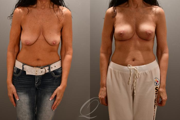 Breast Lift Case 1001762 Before & After Front | Serving Rochester, Syracuse & Buffalo, NY | Quatela Center for Plastic Surgery