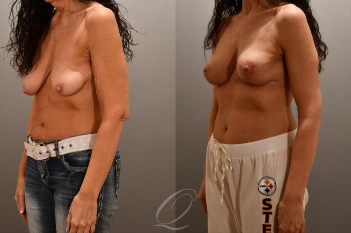 Breast Lift Case 1001762 Before & After Left Oblique | Serving Rochester, Syracuse & Buffalo, NY | Quatela Center for Plastic Surgery