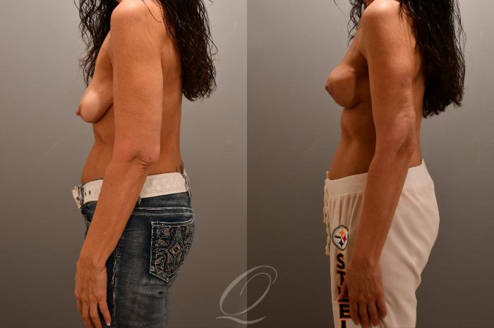 Breast Lift Case 1001762 Before & After Left Side | Serving Rochester, Syracuse & Buffalo, NY | Quatela Center for Plastic Surgery