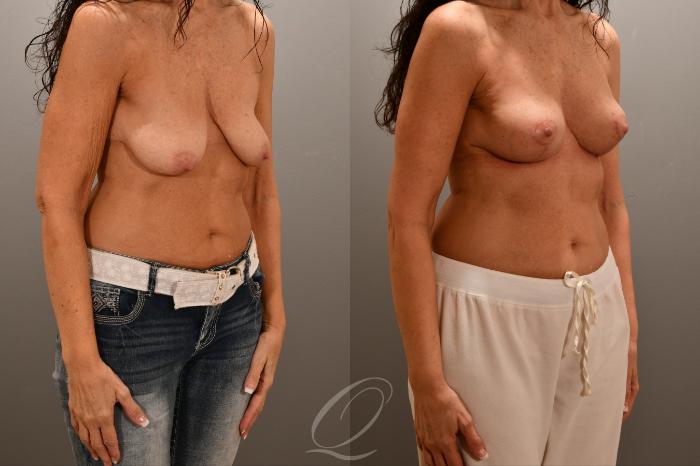 Breast Lift Case 1001762 Before & After Right Oblique | Serving Rochester, Syracuse & Buffalo, NY | Quatela Center for Plastic Surgery